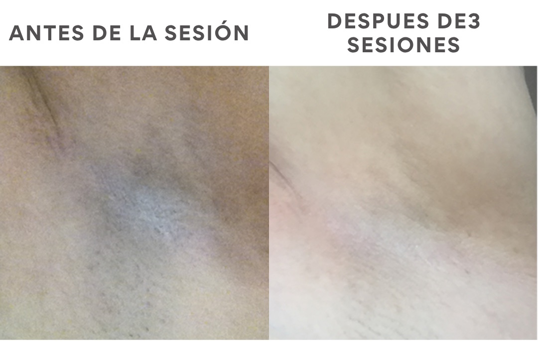 Antes y después de depilación láser en axila tras 3 sesiones