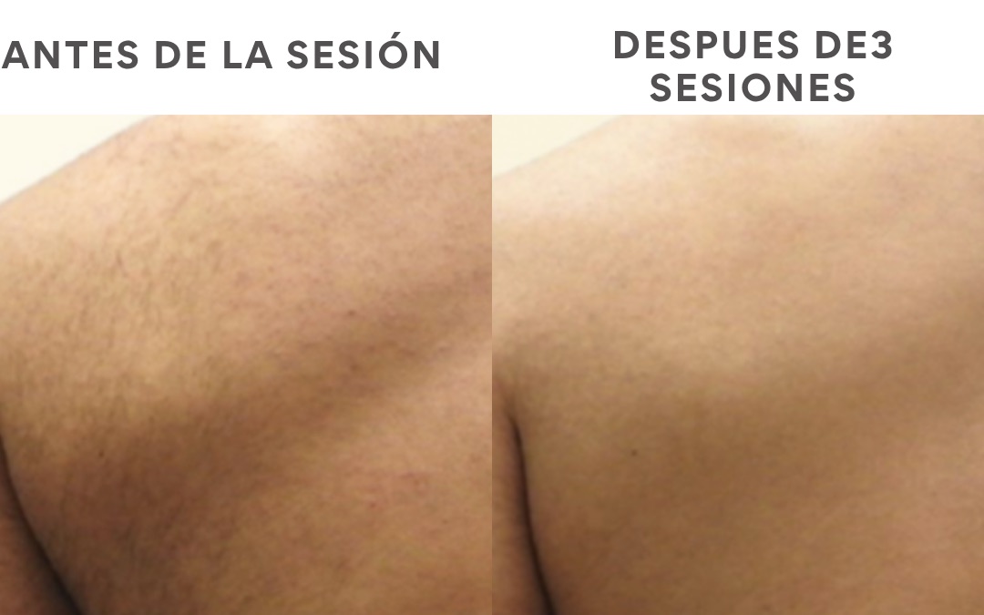 Antes y después de depilación láser, resultado 3