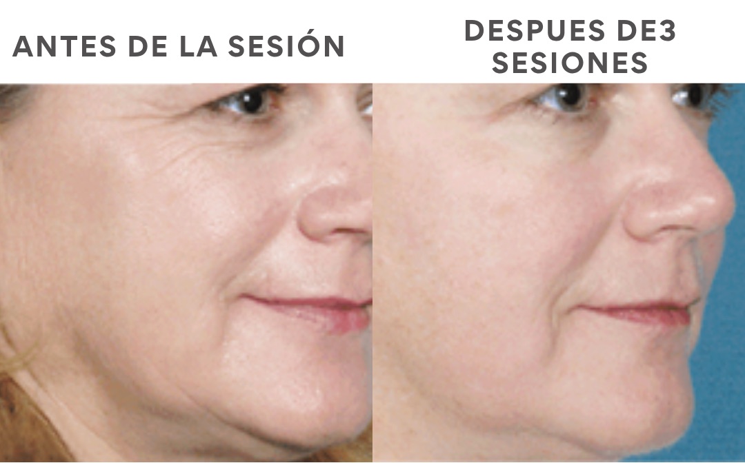 Antes y después de GlowUp Facial con láser