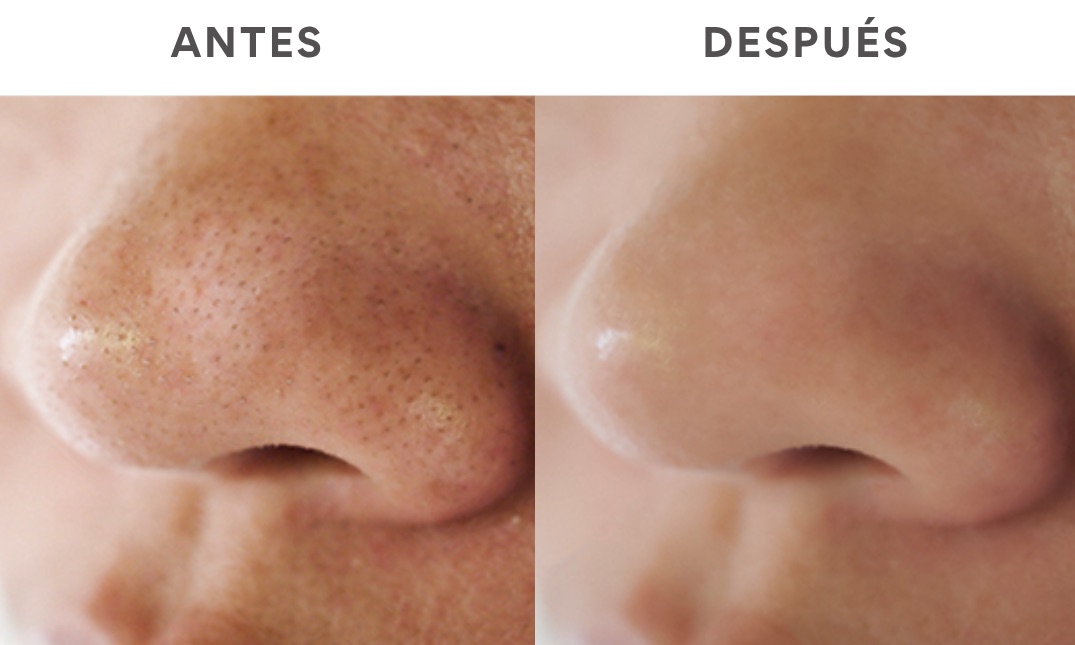 Antes y después de limpieza facial con microdermoabrasión