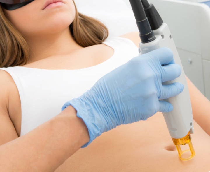 Especialista aplicando tratamiento láser de reducción de estrías en abdomen de clienta